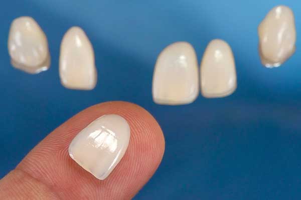 Close Up of Porcelain Veneers