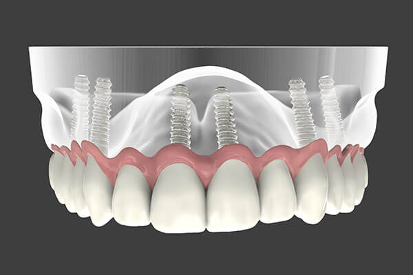 Graphic of Implant Supported Dentures