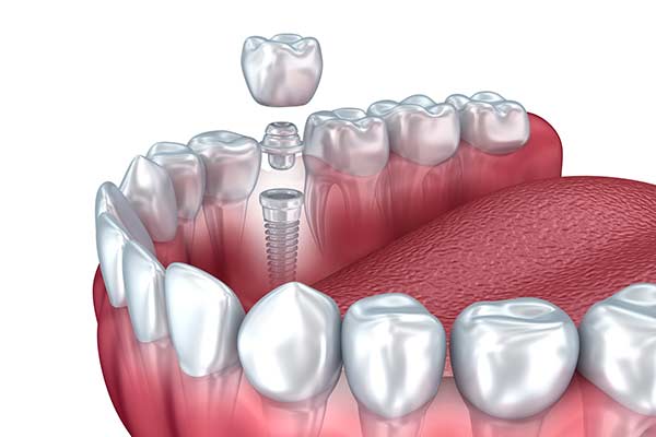 Illustration of Restorative Dental Implant Restorations