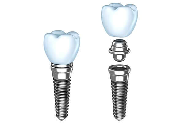 Illustration of Single Tooth Dental Implants