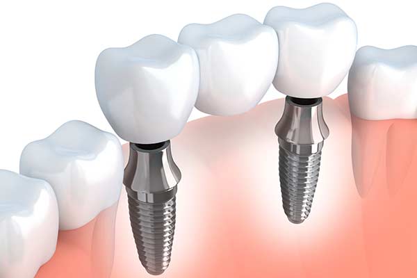 Illustration of Implant Supported Bridges