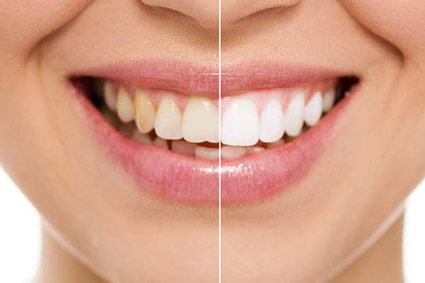 Before and After Showing Benefit of Zoom Teeth Whitening 