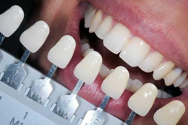 Tooth Shade Guide For Restorative Composite Fillings/Bondings